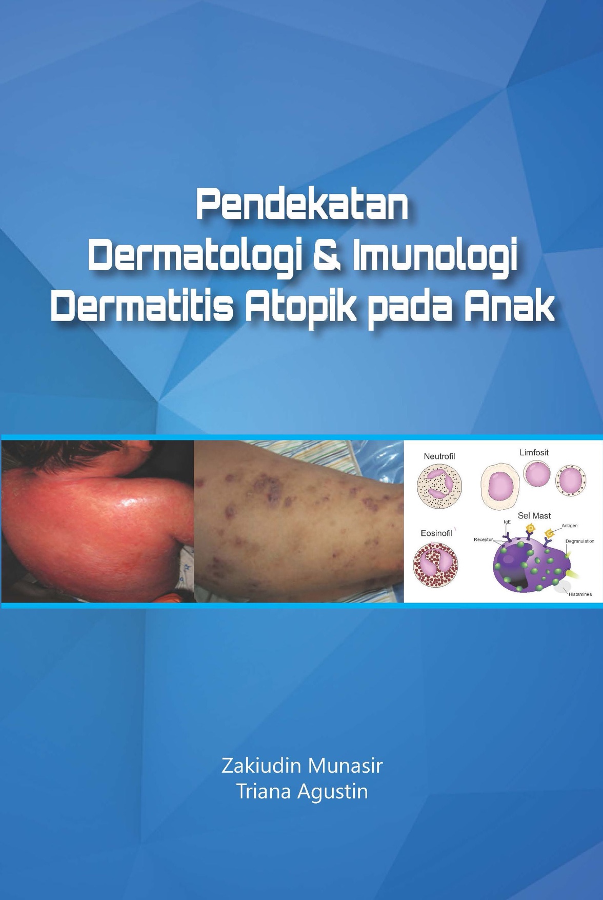 Pendekatan Dermatologi &amp; Imunologi Dermatitis Atopik pada Anak